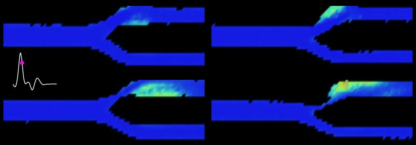 Movie of spectral broadening index derived from Doppler ultrasound measurements in a carotid bifurcation model 